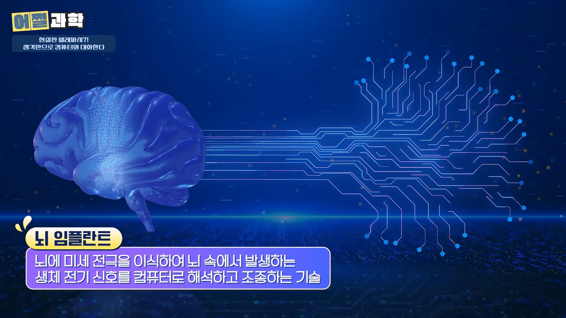 뇌 임플란트